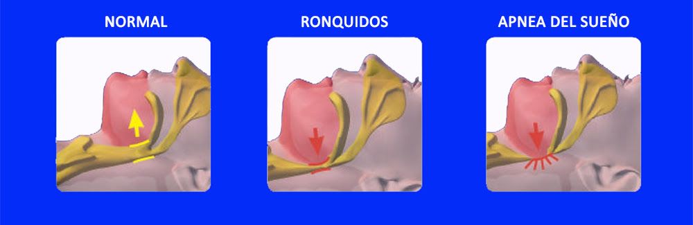 Diagrama anatómico para comparar cómo fluye el aire en el cuerpo durante la respiración normal, los ronquidos y la apnea del sueño.